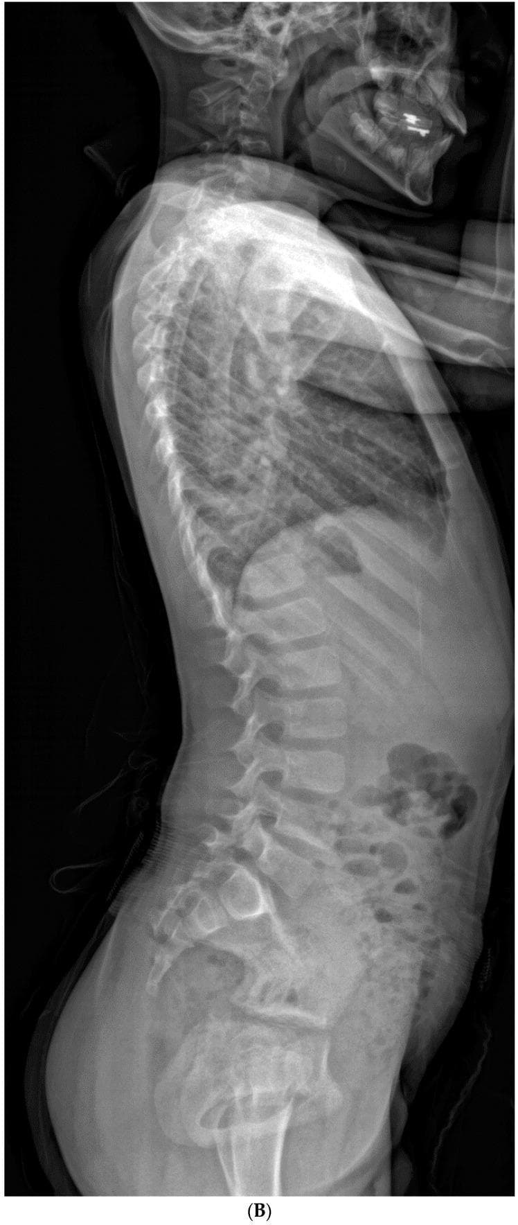 This lateral spinal radiograph of an 8-year-old male demonstrates significant sagittal plane deformity associated with Congenital Cervical Scoliosis (CCS). The image shows a marked cervical kyphosis resulting in a pronounced forward head posture. This cervical deformity is associated with a compensatory increase in lumbar lordosis to maintain sagittal balance. Key anatomical findings include anterior narrowing of intervertebral disc spaces and wedge-shaped vertebral bodies within the cervical region, contributing to the kyphotic curvature. The thoracic spine exhibits a standard kyphotic curve, while the lumbar spine shows increased lordosis. The image illustrates the natural history of spinal compensation where thoracic and lumbar segments adjust their alignment in response to primary cervical vertebral anomalies, such as hemivertebrae or formation failure, in patients with Klippel-Feil syndrome or similar congenital conditions.