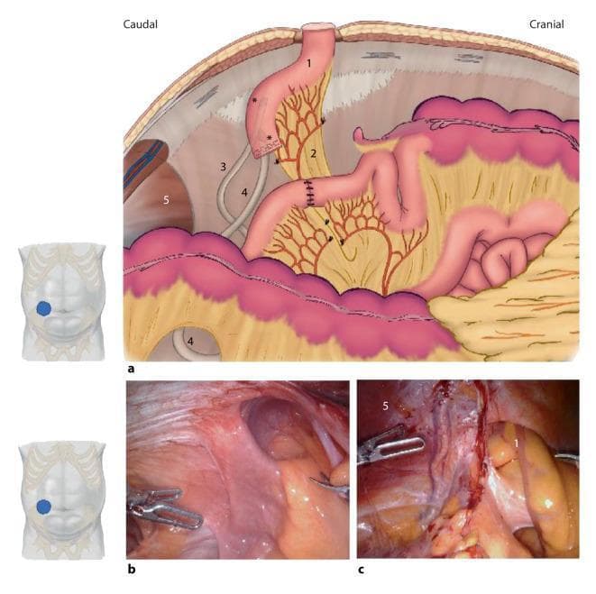 Educational panel illustrating the surgical anatomy and complications of an ileal conduit urinary diversion. Part A is an anatomical diagram showing a cross-section of the abdomen with a focal stoma. Key structures labeled include the ileal conduit (1), its associated mesentery containing vascular supply (2), and the right (3) and left (4) ureters. Asterisks mark the uretero-ileal anastomoses. The posterior abdominal wall is noted as deperitonealized (5) following radical cystectomy. Parts B and C are clinical laparoscopic photographs showing intraoperative views of the same anatomy. Photograph B demonstrates complex fibrous adhesions involving the ileal conduit, a common challenge in parastomal hernia repair. Photograph C shows the pinkish, smooth surface of the deperitonealized posterior abdominal wall (5) adjacent to the textured, tubular ileal conduit (1). Small orientation icons indicate the stoma position on the lower abdominal wall. This content is designed to teach the anatomical changes following cystectomy and the specific challenges of treating parastomal hernias in patients with urinary diversions.
