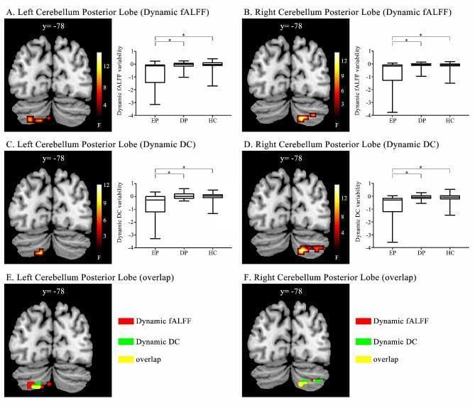This composite diagnostic image presents findings from a functional magnetic resonance imaging (fMRI) study focusing on neuroimaging biomarkers in Bipolar Disorder (BD). The figure is divided into six panels (A–F), displaying coronal brain sections at y = -78, specifically targeting the left and right Cerebellum Posterior Lobe (CPL). Panels A and B illustrate clusters of altered dynamic fractional amplitude of low-frequency fluctuations (dfALFF), while C and D show changes in dynamic degree centrality (dDC). Heat maps overlaid on grayscale structural templates indicate the intensity of these dynamic variabilities. Panels E and F provide a spatial comparison using a color-coded overlap analysis: red represents dfALFF regions, green represents dDC regions, and yellow indicates voxels where both parameters overlap. Accompanying each fMRI slice is a box plot comparing euthymic BD patients (EP), depressed BD patients (DP), and healthy controls (HC). The charts demonstrate significantly lower variability in the euthymic group compared to both depressed patients and healthy controls. This educational graphic illustrates the use of resting-state fMRI metrics to distinguish clinical states within the bipolar spectrum, highlighting the cerebellum's involvement in the pathophysiology of mood disorders.