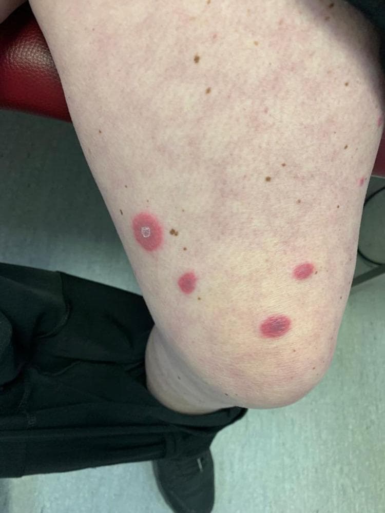 This clinical photograph shows the anterior thigh of a patient with several cutaneous lesions characteristic of Sweet syndrome (acute febrile neutrophilic dermatosis). The primary findings are multiple well-demarcated, erythematous to violaceous, edematous plaques and nodules. The lesions exhibit a scattered distribution across the fair-toned skin. One prominent lesion demonstrates a 'targetoid' or annular morphology with a lighter central zone, while other smaller lesions appear as solid, deep-red papulonodular infiltrates. The surrounding skin shows mild inflammatory erythema but is otherwise intact with visible benign hyperpigmented macules (freckles). These visual features represent classical neutrophilic infiltration of the dermis, often associated with systemic conditions such as inflammatory bowel disease (IBD). This image serves as a teaching tool for recognizing the dermatologic manifestations of reactive neutrophilic dermatoses in a clinical setting.