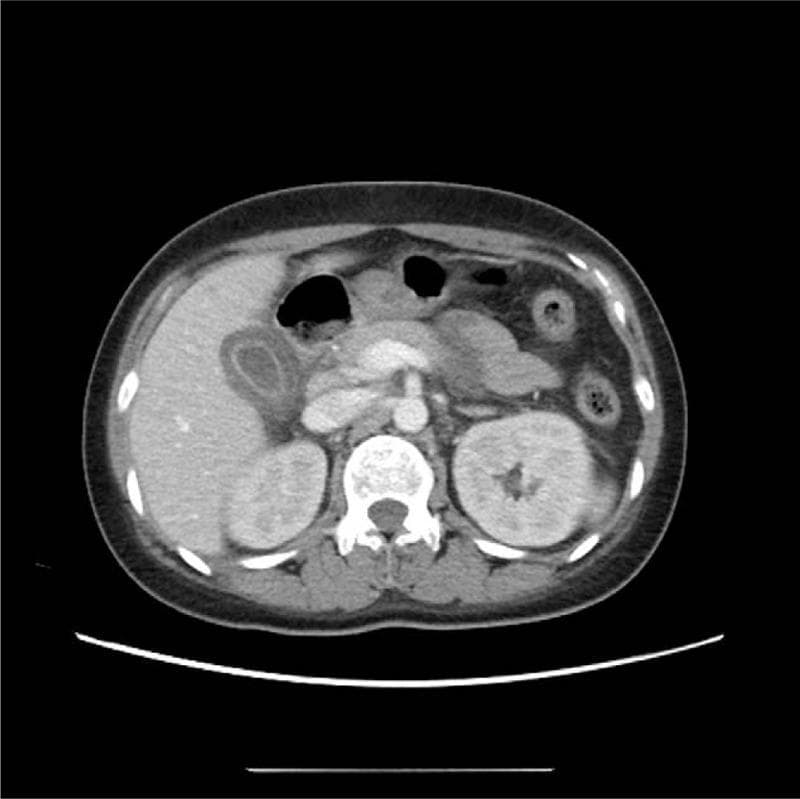 This diagnostic image is an axial slice from a contrast-enhanced abdominal computed tomography (CT) scan. The primary pathology is located in the right upper quadrant, showing significant gallbladder wall thickening and mural edema, creating a 'halo' or layered appearance. There is associated pericholecystic fluid and fat stranding, which are hallmarks of acute cholecystitis. Notably, there are no radiopaque gallstones or sludge visible within the gallbladder lumen, consistent with a diagnosis of acalculous cholecystitis. Other visible abdominal structures include the liver parenchyma, which appears homogeneous; both kidneys, which show normal cortical enhancement; the pancreas; the stomach containing air; and the abdominal aorta. The image serves as a clinical example of secondary gallbladder changes often associated with systemic inflammatory conditions or acute acalculous cholecystitis (AAC). This material is relevant for medical education regarding gastrointestinal imaging and the differential diagnosis of acute abdominal pain.