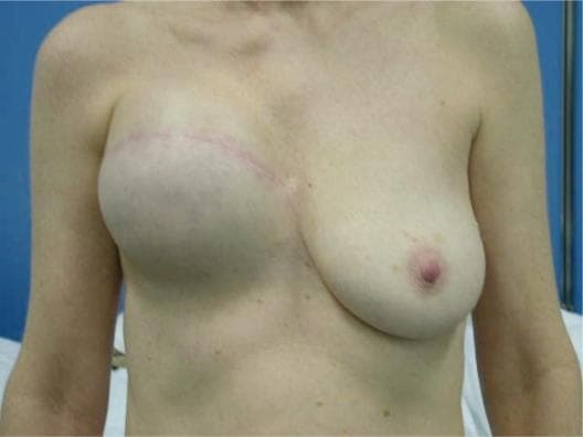 This clinical photograph shows a frontal view of a patient’s chest, illustrating post-mastectomy breast reconstruction with a tissue expander on the right side. The right breast mound appears significantly enlarged, firm, and rounded, lacking the natural ptosis seen in the contralateral left breast. A prominent, transverse surgical scar is visible across the upper quadrant of the right breast, extending medially towards the sternum. The right nipple-areolar complex is absent, likely as a result of a nipple-sparing or total mastectomy followed by primary expansion. In contrast, the left breast displays a natural teardrop shape with a normal nipple-areolar complex and typical skin pigmentation. This image serves as an educational example of the second stage of breast reconstruction (expansion phase), demonstrating the volumetric difference between a prosthetic expander and native breast tissue. It is relevant for plastic and reconstructive surgery training, specifically focusing on oncology-related breast restoration and the management of tissue expanders.