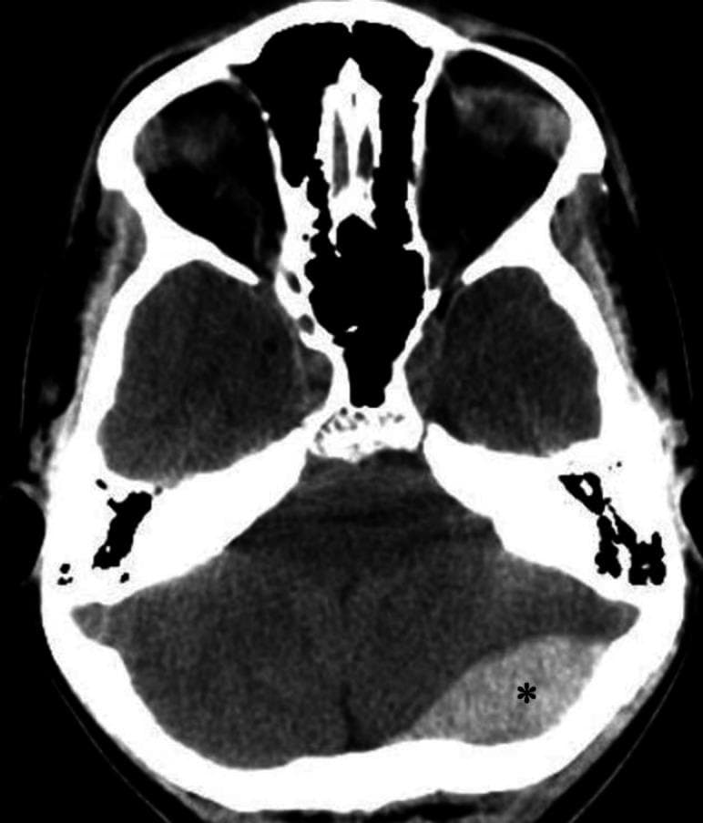 An axial non-contrast computerized tomography (CT) scan of the brain demonstrating an acute epidural (extradural) hematoma. The primary finding is a well-defined, biconvex (lens-shaped), hyperdense fluid collection located in the left occipital region, marked with an asterisk. This hyperdensity is characteristic of an acute hemorrhage within the epidural space, which typically does not cross cranial sutures. Secondary mass effect is visible, characterized by a mild left-to-right midline shift and compression of adjacent brain parenchyma. Anatomical landmarks include the skull base, posterior fossa structures, and the cerebellum. The image illustrates a classic neurosurgical emergency often associated with traumatic skull fractures and arterial bleeding, typically from the middle meningeal artery. This diagnostic image is intended for educational use in emergency medicine, radiology, and neurology to distinguish epidural hematomas from crescent-shaped subdural hematomas.