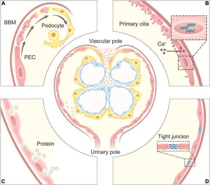 This medical illustration depicts the anatomical structure and physiological functions of Parietal Epithelial Cells (PECs) within the renal Bowman's capsule. A central diagram shows a cross-section of a glomerulus, identifying the vascular pole, urinary pole, and the Bowman’s basement membrane (BBM). Surrounding this are four detailed panels (A-D) highlighting specific cellular mechanisms. Panel A illustrates the progenitor role of PECs, showing their proliferation and differentiation into podocytes within the glomerular tuft. Panel B demonstrates mechanosensation, where primary cilia on PECs detect filtrate flow, triggering intracellular calcium (Ca+) influx and gene expression changes. Panel C shows protein uptake via endocytosis during glomerular ultrafiltrate overload. Panel D highlights the barrier function, showing tight junctions between PECs that prevent protein leakage into the extraglomerular space. The diagram serves as an educational tool for renal physiology and pathophysiology, focusing on the role of the glomerular filtration barrier and the dynamic contributions of the parietal epithelium to kidney homeostasis and repair.
