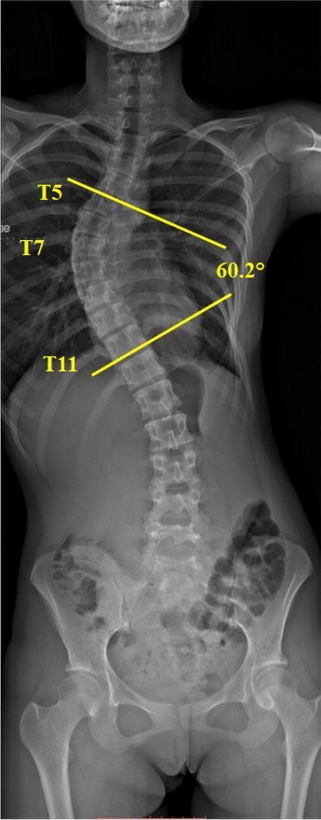This diagnostic image is a posteroanterior (PA) standing radiograph of the full spine, demonstrating Adolescent Idiopathic Scoliosis (AIS). The visual focus is on a significant lateral curvature of the thoracic spine with a right-sided convexity. The Cobb angle, a gold-standard radiological measurement for quantifying the degree of scoliosis, is illustrated using yellow annotation lines. These lines are drawn parallel to the superior endplate of the T5 vertebral body (the upper end vertebra) and the inferior endplate of the T11 vertebral body (the lower end vertebra). The apex of the curve is identified at the T7 level. The measured Cobb angle is indicated as 60.2°, classifying this as a severe scoliotic deformity. The radiograph also captures the cervical spine, lumbar spine, and pelvis, providing a comprehensive view of spinal alignment. This image serves as an educational tool for identifying anatomical landmarks in scoliosis assessment and demonstrating the clinical application of Cobb angle measurement in orthopedic diagnostics.