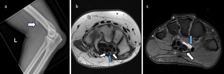 A three-part diagnostic image series illustrating anatomical and pathological causes of median nerve entrapment. Panel A: Lateral X-ray of the elbow showing a supracondylar spur (white arrow) on the distal humerus, a risk factor for nerve impingement at the ligament of Struthers. Panel B: Axial proton density (PD) MRI of the wrist at the carpal tunnel level. It demonstrates a bifid median nerve variant, visualized as two distinct nerve bundles (white arrows), accompanied by a persistent median artery (blue arrow), both of which can reduce available space within the tunnel. Panel C: Axial T2-weighted or PDFS MRI of the wrist showing a hyperintense ganglion cyst (blue arrow) encroaching upon the carpal tunnel. The cyst causes significant extrinsic compression and flattening of the adjacent median nerve (white arrow), resulting in a pathological width-to-height ratio exceeding 3. These images are essential for understanding musculoskeletal radiology and the mechanical etiologies of carpal tunnel syndrome.