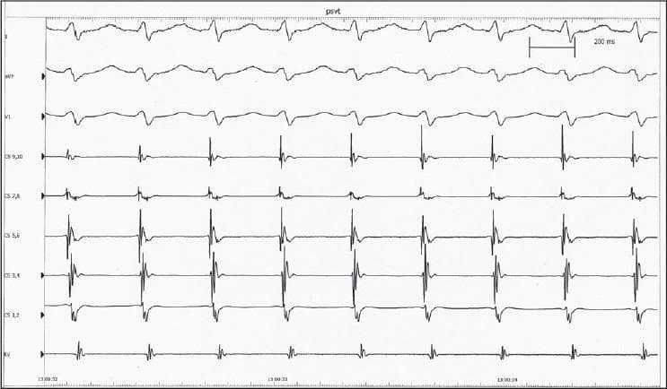 This diagnostic image displays an intracardiac electrogram (EGM) recorded during an electrophysiology (EP) study, demonstrating paroxysmal supraventricular tachycardia (PSVT), specifically atrioventricular nodal reentrant tachycardia (AVNRT). The tracing includes surface ECG leads (I, aVF, V1) and multiple intracardiac channels: distal to proximal coronary sinus electrograms (CS 9-10, CS 7-8, CS 5-6, CS 3-4, CS 1-2) and a right ventricular (RV) lead. The surface ECG shows a narrow QRS complex tachycardia with a regular rhythm. Within the coronary sinus leads, the atrial (A) and ventricular (V) electrograms are interfused or nearly simultaneous, characterized by a very short ventriculoatrial (VA) interval. This near-simultaneity of atrial and ventricular activation is a hallmark of typical (slow-fast) AVNRT, where retrograde atrial activation occurs almost concurrently with ventricular depolarization. The image includes a 200 ms scale bar for timing analysis. This material is used to teach medical students and cardiology fellows how to identify re-entrant tachycardia circuits using catheter-based spatial and temporal activation patterns.