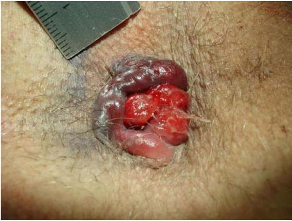 This clinical photograph displays a detailed view of the perianal region demonstrating circular perianal thrombosis and prolapsed hemorrhoids. The central focus shows bright red, lobulated, prolapsing internal hemorrhoids protruding through the anal canal, characterized by a glossy, friable appearance indicative of active or recent bleeding. Surrounding these is a prominent, circular area of dark purple to bluish discoloration consistent with thrombosed external hemorrhoids. Significant edema and swelling are visible in the associated perianal tissue, particularly involving concomitant anal tags on the left-lateral aspect. The surrounding skin is hirsute and shows localized bruising. A medical ruler is partially visible at the top left of the frame for size reference. This image serves as an educational example of advanced hemorrhoidal disease, illustrating the coexistence of grade IV internal prolapse with acute external venous thrombosis and tissue edema.