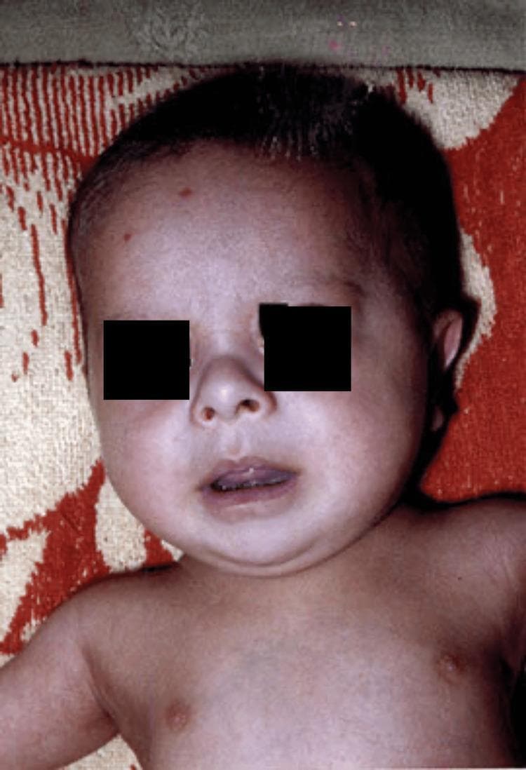 This clinical photograph shows the head and torso of a four-month-old infant, highlighting classic craniofacial dysmorphism associated with Trisomy 21 (Down Syndrome). Visible features include a prominent flat nasal bridge and a depressed nasal root, contributing to a flattened facial profile. The infant exhibits upslanting palpebral fissures (partially obscured for privacy) and a slightly protruding tongue (macroglossia or relative macroglossia). The head shape suggests a flat occiput, and the ears appear small and low-set. These phenotypic markers are key diagnostic indicators in pediatric genetics. The image serves as a clinical reference for identifying midface hypoplasia and other soft markers of chromosomal abnormalities during physical examination. The medical specialty is Pediatrics and Medical Genetics, intended for educational identification of syndromic facies.