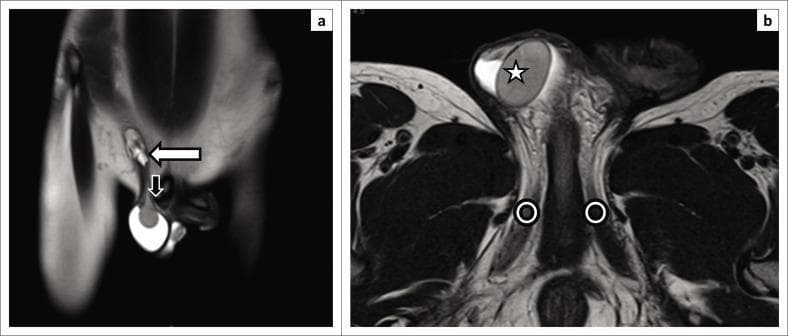 This diagnostic image consists of two T2-weighted magnetic resonance imaging (MRI) scans from a 9-month-old male child, illustrating cryptorchidism (undescended testis). Panel (a) is a coronal section showing a bright, oval T2-hyperintense structure representing the undescended right testis, localized at the level of the root of the penis and near the pubic tubercle (indicated by a black arrow). The inguinal canal is visible superiorly, marked with a white arrow. Panel (b) is an axial section further detailing the anatomical relationships; the undescended testis (star) is situated superficially. The crura of the penis are identified bilaterally (circles), located medial and inferior to the ectopic testicular position. These images demonstrate the high sensitivity of MRI in localizing non-palpable or ectopic testes by providing clear contrast between the hyperintense testicular tissue and surrounding pelvic anatomy, which is essential for preoperative surgical planning and preventing complications like atrophy or malignancy.