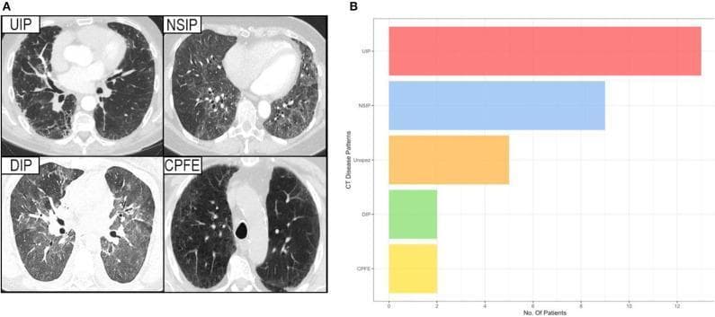 This composite educational resource consists of a diagnostic imaging panel (A) and a comparison bar chart (B) illustrating interstitial lung disease (ILD) patterns in patients with Sjögren's syndrome. Panel A displays axial High-Resolution Computed Tomography (HRCT) slices of four distinct ILD patterns: Usual Interstitial Pneumonia (UIP) characterized by peripheral reticulation and honeycombing; Non-Specific Interstitial Pneumonia (NSIP) showing more uniform ground-glass opacities; Desquamative Interstitial Pneumonia (DIP) with diffuse ground-glass attenuation; and Combined Pulmonary Fibrosis and Emphysema (CPFE) demonstrating upper-lobe emphysematous lucencies alongside fibrotic changes. Panel B is a horizontal bar chart quantifying the prevalence of these CT disease patterns among the study cohort. The chart indicates that UIP is the most frequent pattern, followed by NSIP, unspecific changes (Unspez), and lastly DIP and CPFE, which show equal, lower prevalence. This visual aid is intended for medical education regarding the radiologic classification and epidemiological distribution of pulmonary manifestations in systemic autoimmune diseases.