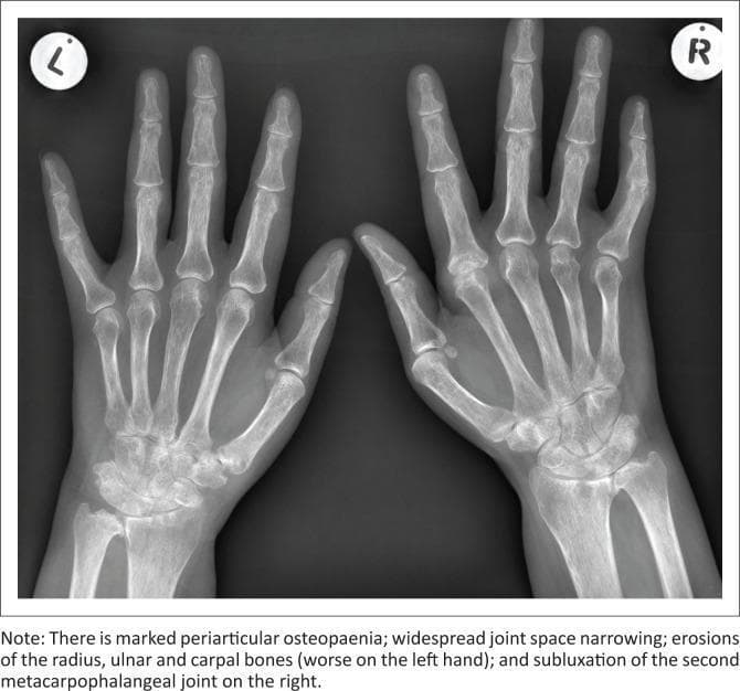 A frontal (posteroanterior) radiograph of both hands and wrists, demonstrating classic radiographic features of Rheumatoid Arthritis. The image shows bilateral, relatively symmetrical involvement. Key findings include marked periarticular osteopenia, most notable around the metacarpophalangeal (MCP) and proximal interphalangeal (PIP) joints. Extensive cortical erosions are visible within the carpal bones, distal radius, and ulna, with more advanced destruction appearing on the left side. There is widespread, uniform narrowing of the joint spaces throughout the carpal, MCP, and PIP joints. Additionally, subluxation is noted at the second MCP joint of the right hand, indicating significant ligamentous and articular instability. The distribution and nature of these findings (erosions, osteopenia, symmetry, and joint narrowing) are highly characteristic of chronic inflammatory erosive arthritis. This diagnostic image serves as an educational example for identifying structural damage and joint malalignment in systemic rheumatologic conditions.