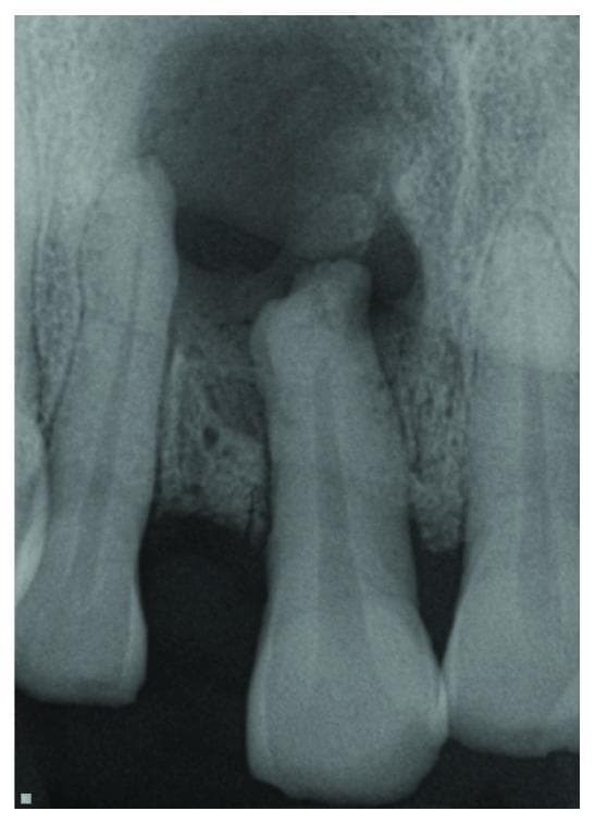 This diagnostic periapical radiograph focuses on the anterior maxilla, specifically depicting the permanent maxillary right central incisor (tooth #8). The most prominent feature is a large, well-defined, unilocular radiolucency originating at the apex of tooth #8 and extending superiorly and laterally. This radiolucent area signifies significant alveolar bone resorption or a cystic/granulomatous lesion, likely resulting from chronic pulpal necrosis. The borders of the lesion appear relatively smooth, displacing the normal trabecular bone pattern. Tooth #8 shows an intact crown but exhibits pathological changes in the root apex which is submerged within the radiolucency. The adjacent teeth (upper left central and upper right lateral incisors) are visible at the periphery, showing the extent of the lesion's involvement in the interdental bone spaces. This image is a classic representation of periapical pathology, such as a radicular cyst or periapical granuloma, secondary to a non-vital tooth.