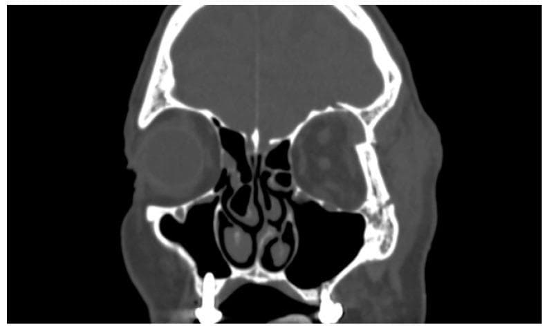 This diagnostic image is a coronal Computed Tomography (CT) scan of the maxillofacial region, focusing on the orbits and paranasal sinuses. The scan reveals a significant fracture of the left zygomaticomaxillary complex, specifically involving the lateral orbital wall and the orbital floor. Key findings include clear cortical discontinuity, fragmentation, and displacement of the lateral bony margin of the left orbit compared to the intact contralateral side. There is associated soft tissue swelling and potential herniation of orbital contents into the adjacent maxillary sinus space. The left globe appears slightly displaced and distorted relative to the normal spherical morphology of the right globe. Anatomical landmarks such as the nasal septum, turbinates, and maxillary sinuses are visible, with the left maxillary sinus demonstrating opacity likely representative of hemorrhage or herniated orbital tissue. This clinical presentation is characteristic of midface trauma and serves as a primary diagnostic tool for evaluating orbital wall integrity and planning surgical reconstruction in patients presenting with symptoms like diplopia or enophthalmos.