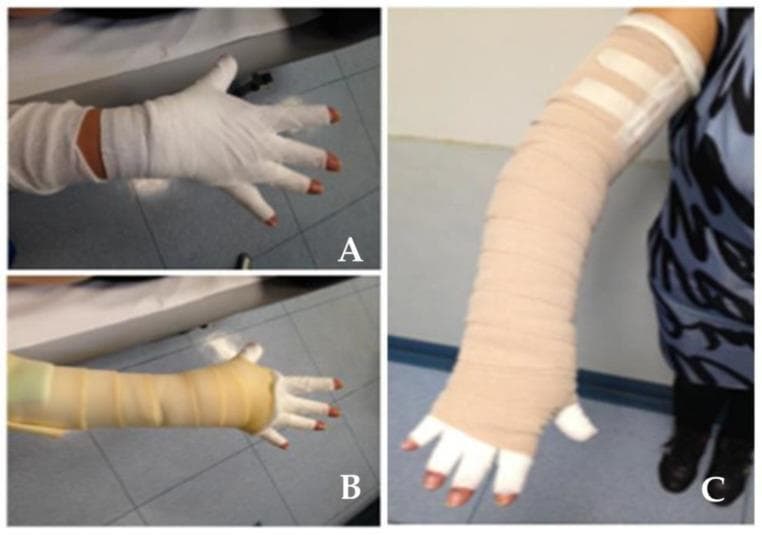This clinical photograph illustrates three stages (A, B, and C) of applying multi-layer compression bandaging for the management of lymphedema in the upper limb. Panel A shows the initial layer on the hand and wrist, utilizing a white, conforming cotton-based material that covers the palm, dorsum, and individual fingers while leaving the distal fingertips exposed for neurovascular monitoring. Panel B demonstrates the progression, where a secondary, tan-colored short-stretch compression bandage is applied over the wrist and proximal forearm, overlapping the initial hand wrap. Panel C depicts the completed compression garment extending from the hand to the proximal upper arm, just below the shoulder. The final layer consists of tan, textured short-stretch bandages applied in a spiral or herringbone pattern to provide high working pressure and low resting pressure, facilitating lymphatic drainage. The proximal end is secured with white adhesive medical tape. This visual illustrates the distal-to-proximal gradient compression technique essential in Complete Decongestive Therapy (CDT).