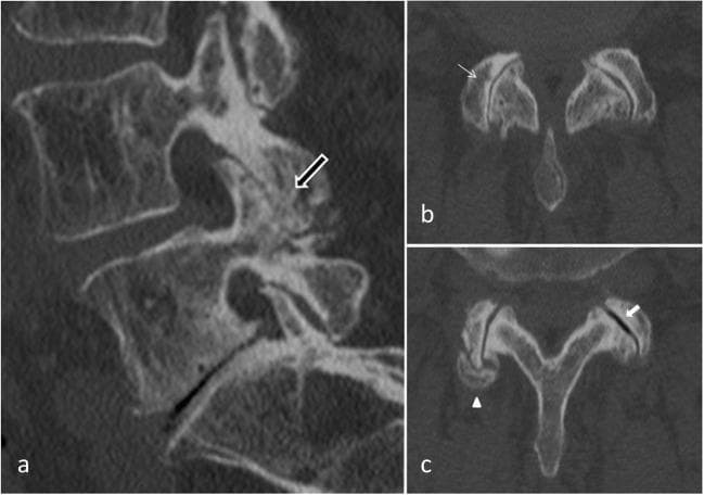 Diagnostic computed tomography (CT) scans of the lumbar spine illustrating hallmark signs of degenerative facet joint osteoarthritis (FJOA). View (a) is a sagittal reconstruction demonstrating significant hypertrophy of the posterior articular process (black arrow), which appears enlarged and sclerotic. Views (b) and (c) are axial images highlighting the bilateral synovial joints. Key diagnostic features shown include: 1) Joint space narrowing (thin white arrow in b), indicating loss of articular cartilage; 2) Vacuum phenomenon (white arrow in c), represented by intra-articular gas due to negative pressure within the degenerated joint; and 3) Joint capsule calcification (white arrowhead in c), appearing as dense, mineralized areas within the peripheral soft tissues. These findings collectively represent chronic degenerative changes in the 'three-joint complex' of the spinal segment, frequently associated with axial low back pain and mechanical instability.