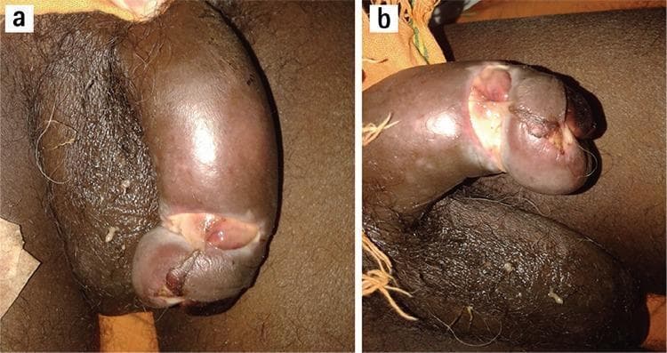 Two-panel clinical photograph (a and b) illustrating a severe case of paraphimosis leading to penile gangrene. Image (a) shows the penis in a state of acute vascular compromise. The glans penis is markedly discolored with a dark purple to black hue, indicative of ischemia. A clear paraphimotic ring is visible where the retracted foreskin is trapped behind the coronal sulcus, causing significant mechanical constriction and proximal shaft edema. Image (b) shows the progression to dry gangrene. The glans exhibits extensive tissue necrosis, sloughing of the skin, and ulceration. The structural integrity is compromised with visible loss of viable tissue and a shriveled, distorted appearance. The anatomical focus is the urogenital system, specifically demonstrating the complications of untreated paraphimosis in an adult male. This visual resource is intended for medical education regarding urological emergencies and the identification of necrotic skin lesions in a clinical setting.