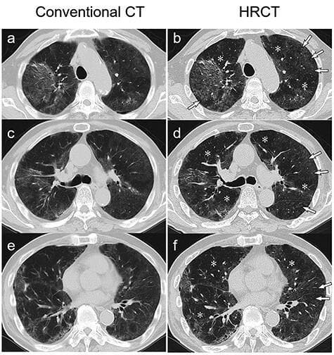 This diagnostic image provides a side-by-side comparison between conventional 5-mm-thick axial CT scans (panels a, c, e) and 2-mm-thick high-resolution CT (HRCT) scans (panels b, d, f) of the chest. The imaging captures three anatomical levels: the aortic arch, the tracheal carina, and the aortic valve. Both modalities demonstrate diffuse, bilateral ground-glass opacities (GGOs) with a predominant peripheral distribution. However, the HRCT images offer superior detail for characterizing parenchymal lung disease. Specifically, the HRCT scans reveal ill-defined centrilobular nodules (indicated by arrows) and distinct areas of mosaic attenuation (indicated by asterisks), characterized by alternating regions of varying lung density. These visual markers are key diagnostic features of hypersensitivity pneumonitis (HP), such as humidifier lung, and serve as important radiographic findings to differentiate HP from other interstitial lung diseases or viral pneumonias like COVID-19.