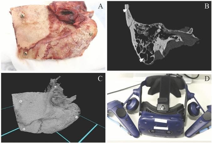 This composite educational image illustrates the multimodal representation of human temporal bone (TB) anatomy for surgical training. Panel A shows a clinical photograph of a fresh frozen temporal bone specimen, displaying natural coloration with red hues from residual soft tissue and blood vessels. Five titanium fiducial marker screws are visible, placed at predefined locations (squamous part, mastoid tip, and petrous part) for measurement validation. Panel B presents a 2D high-resolution computed tomography (HRCT) image in a grayscale bone window, clearly detailing internal structures like mastoid air cells and the bony labyrinth. Panel C displays a 3D virtual reality (VR) reconstruction of the specimen, emphasizing surface morphology and the spatial orientation of the fiducial markers within a digital environment. Panel D shows the hardware used for interaction, specifically an HTC Vive Pro head-mounted display and controllers. The set demonstrates the translation of physical specimens into diagnostic imaging and immersive VR simulations for otologic surgical planning and anatomical study.