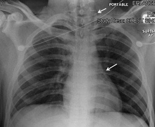 This diagnostic image is an anteroposterior (AP) chest radiograph demonstrating classic signs of barotrauma or air leak. The primary findings include subcutaneous emphysema and pneumomediastinum. Radiographically, subcutaneous emphysema is visible as linear and mottled streaks of air (radiolucency) within the soft tissues of the neck and supraclavicular regions, indicated by the upper arrow. Additionally, the lower arrow highlights pneumomediastinum, characterized by a thin, vertically oriented radiolucent line or gas stripe outlining the left cardiac border and mediastinal pleura. This 'continuous diaphragm sign' or 'spinnaker sail' equivalent suggests free air tracking within the mediastinal space. The clinical context involves a patient with diabetic ketoacidosis (DKA) and Kussmaul respirations, which can lead to alveolar rupture (Macklin effect) and subsequent air dissection. This image is an essential educational resource for identifying extra-alveolar air in pulmonary and emergency medicine.