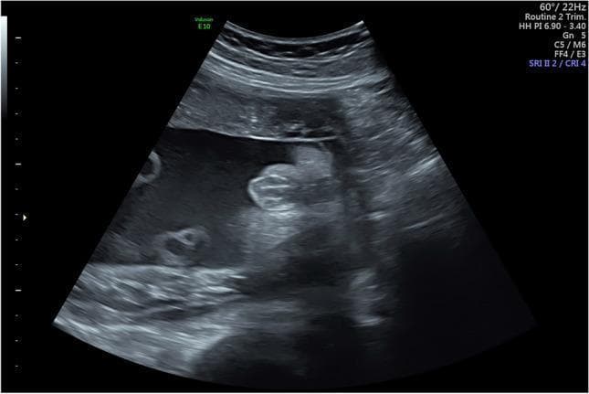 This diagnostic ultrasound image demonstrates the external genitalia of a female fetus at 30 weeks and 4 days of gestation. The primary sonographic finding is the 'multiple parallel linear echo pattern' (also known as the hamburger sign), which is characteristic of the developing labia majora and labia minora. This pattern consists of three or more hyperechoic, parallel lines representing the labial folds, often separated by a thin hypoechoic midline cleft. The image is captured in a transverse perineal plane, clearly showing the absence of a male phallus or scrotum. This visualization is a key educational marker used in prenatal imaging to confirm female fetal sex and assess normal urogenital development in the third trimester. The surrounding structures include the anechoic amniotic fluid and adjacent fetal limbs, providing context for the perineal orientation.