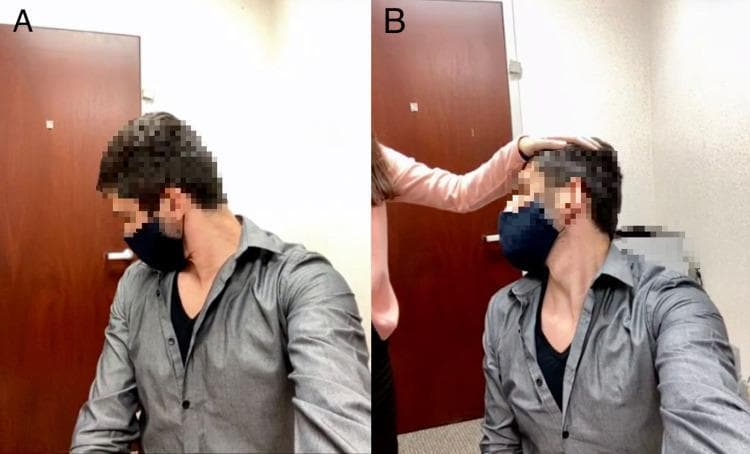 Clinical photographs demonstrating physical examination maneuvers for cervical radiculopathy. Panel A illustrates the forward flexion test, showing a patient with the head rotated to the side and the neck flexed anteriorly. Panel B demonstrates the Spurling test (foraminal compression test), where an examiner applies a downward axial load to the apex of the patient's head while the neck is rotated toward the symptomatic side. These provocative maneuvers are used to evaluate cervical nerve root irritation or impingement; a positive result is indicated by the reproduction of radicular pain radiating into the shoulder or arm. The images show a clinical setting with the patient in a seated position. These tests are essential components of a neurological neck examination to differentiate cervical spine pathology from shoulder-related disorders.
