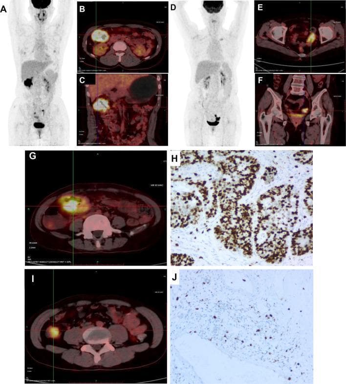 This composite image illustrates diagnostic findings in colorectal cancer (CRC) patients, focusing on 18F-FDG PET/CT imaging and immunohistochemistry (IHC). Panels A, B, and C display a patient with mutated-type KRAS, featuring a Maximum Intensity Projection (MIP) whole-body scan (A) and cross-sectional PET/CT fusions (B, axial; C, coronal) showing intense radiotracer accumulation in the hepatic flexure (SUV 20.0). Panels D, E, F, G, and I represent CRC patients with wild-type KRAS or general sigmoid involvement, showing MIP views and axial/coronal slices with 18F-FDG uptake in the sigmoid colon (SUVs ranging from 12.4 to 21.3). The radiologic images highlight the localization of primary lesions using functional metabolic activity. Panels H and J provide corresponding histological evidence via Ki-67 IHC staining. Panel H demonstrates a high proliferation index (77.8%) with dense, dark brown nuclear staining in tumor cells, while Panel J shows a lower proliferation index (22.7%) with sparse staining. This educational visual correlates metabolic imaging intensity (SUVmax) with molecular markers (KRAS status) and cellular proliferation (Ki-67) in the context of oncological staging and pathology.
