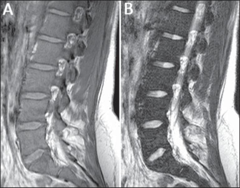 This diagnostic image consists of two sagittal MRI views of the lumbar spine from a 22-year-old patient with Gaucher's disease: a T1-weighted image (A) and a T2-weighted image (B). The primary finding is diffuse bone marrow infiltration, which manifests as a significant decrease in marrow signal intensity across the vertebral bodies. In image A (T1), the vertebral bone marrow appears abnormally hypointense compared to the hyperintense intervertebral discs and presacral fat. In image B (T2), the marrow remains dark, further emphasizing the displacement of normal fatty marrow by Gaucher cells. Additionally, there is a visible loss or replacement of the high-signal fat that normally surrounds the basivertebral veins. This pattern of signal change—marrow becoming darker than the adjacent discs on T1 sequences—is a hallmark of infiltrative marrow disorders. The images serve as an educational example of how systemic metabolic diseases like Gaucher's disease can be staged using MRI-based bone marrow burden (BMB) scoring systems.