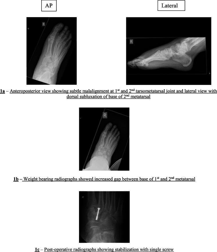 This set of diagnostic radiographs illustrates the clinical presentation and surgical management of a Lisfranc (tarsometatarsal) joint injury in a human foot. Image 1a provides pre-operative anteroposterior (AP) and lateral views. The AP view shows subtle malalignment at the 1st and 2nd tarsometatarsal joints, while the lateral view demonstrates dorsal subluxation of the 2nd metatarsal base. Image 1b is a weight-bearing AP radiograph, which emphasizes the pathology by revealing a pronounced 'fleck sign' or diastasis (increased gap) between the bases of the 1st and 2nd metatarsals, a key diagnostic feature of Lisfranc instability. Image 1c is a post-operative AP view showing surgical stabilization. A single cannulated or cortical screw has been placed across the tarsometatarsal joint, specifically bridging the medial cuneiform and the base of the second metatarsal to restore anatomical alignment and stability. This series serves as an educational tool for identifying subtle orthopedic injuries that can be easily missed on non-weight-bearing films and demonstrates standard internal fixation techniques in podiatric or orthopedic surgery.