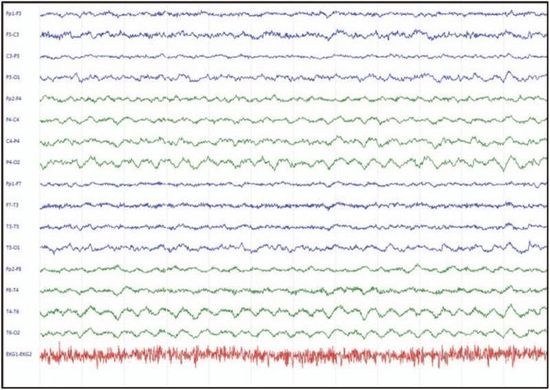 This diagnostic image displays a multi-channel electroencephalogram (EEG) tracing highlighting the 'extreme delta brush' (EDB) pattern, a visual hallmark of anti-NMDAR encephalitis. The recording includes several longitudinal bipolar montage channels (ranging from Fp1-F3 to T6-O2) and a bottom rhythm strip for EKG monitoring. The primary neurophysiological finding consists of rhythmic, high-amplitude slow waves in the delta frequency range (1–3 Hz), which are superimposed with bursts of fast, low-amplitude beta activity (20–30 Hz) riding on the crest or trough of each delta wave. This characteristic morphology is most prominent in the bilateral frontal and temporal leads (e.g., Fp1-F3, Fp2-F4, T3-T5, T4-T6), suggesting a bifrontal and bitemporal predominance. In contrast, the parietal and occipital channels show a relatively more organized but still slowed background activity. This pattern is clinically significant for the diagnosis of autoimmune encephalitis and helps differentiate movement disorders from status epilepticus in acute clinical settings.