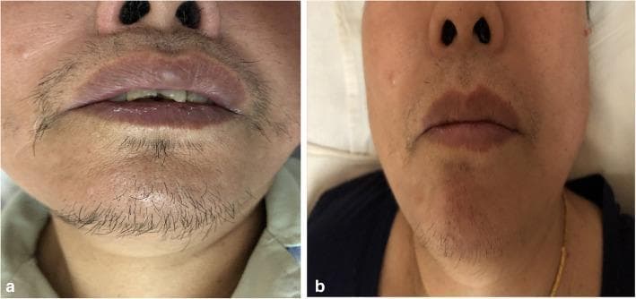 This clinical comparison photograph illustrates the resolution of hirsutism in a 69-year-old female patient following the surgical removal of a Leydig Cell Tumor (LCT). Image (a) represents the pre-operative state, showing prominent male-pattern terminal hair growth on the upper lip (mustache area) and chin. The hair is dark, coarse, and relatively dense, characteristic of hyperandrogenism. Image (b) shows the post-operative result, demonstrating a significant reduction in terminal hair density and thickness in the same facial regions. The remaining hair is sparse and fine, indicating clinical improvement of virilization symptoms. The images serve as an educational example of the cutaneous manifestations of androgen-secreting ovarian tumors and the subsequent reversal of secondary sexual characteristics after hormonal normalization. Key educational concepts include the clinical signs of hyperandrogenemia in postmenopausal women and the diagnostic importance of recognizing sudden-onset hirsutism as a marker for underlying endocrine-active neoplasms like sex cord-stromal tumors.