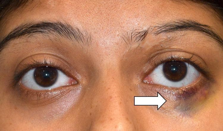 This clinical photograph shows a close-up, frontal view of a patient's periorbital region, demonstrating unilateral ecchymosis of the left lower eyelid. A white arrow points to a localized area of significant skin discoloration characterized by deep purple and blue hues, transitioning into yellowish-green tones at the periphery, indicative of blood extravasation in different stages of breakdown. There is associated mild edema and a palpable nodular mass noted in the clinical history, though only the superficial bruising and slight swelling of the infraorbital soft tissue are visually evident. The right eye and periorbital area appear normal, providing a clear comparison of the pathology. This image is used to illustrate clinical findings associated with orbital trauma or an occult foreign body, emphasizing the importance of detailed physical examination and imaging in cases of localized periorbital bruising.