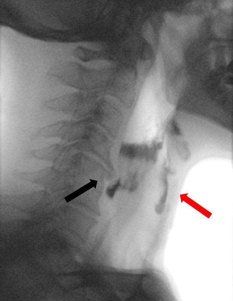 A lateral view videofluoroscopic swallowing study (VFSS) image demonstrating oropharyngeal dysphagia. The image captures the cervical spine and the pharyngeal/esophageal soft tissue structures during the transit of a radiopaque contrast bolus. A prominent anterior osteophyte at the C5 vertebral body level (indicated by a black arrow) causes focal extrinsic compression and narrowing of the proximal cervical esophagus. This mechanical obstruction leads to the stasis and pooling of the contrast material above the upper esophageal sphincter. Significantly, contrast is seen misdirected into the laryngeal vestibule and trachea (indicated by a red arrow), confirming laryngeal penetration and tracheal aspiration. This diagnostic image illustrates the clinical relationship between cervical spondylosis (DISH or severe osteophytosis) and mechanical dysphagia, highlighting the risk of respiratory complications due to impaired bolus clearance and subsequent airway entry.