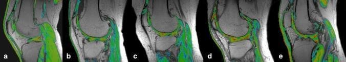 This diagnostic image series presents a side-by-side comparison of T2 mapping MRI pseudocolor scans of the knee joint, illustrating the progression of osteoarthritis (OA) through the Recht grading system. The sequence (a–e) demonstrates the transition from normal articular cartilage to Grade IV OA. (a) Normal: Shows smooth, continuous cartilage with a uniform yellow-green color. (b) Grade I: Displays uneven cartilage thickness and the emergence of spot-like red colorations, indicating early matrix changes. (c) Grade II: Visualizes surface frizziness and mild joint space narrowing with irregular red gradations. (d) Grade III: Shows severe contour irregularity, visible cartilage defects, and highly mixed pseudocolor distribution. (e) Grade IV: Exhibits full-thickness cartilage defects, exfoliation, significant joint space narrowing, subchondral bone exposure, and extensive osteophyte formation. Clinically, these color shifts—from uniform green to heterogeneous red—reflect alterations in water content and collagen integrity, serving as a quantitative tool for assessing cartilage degeneration and osteoarthritis severity.