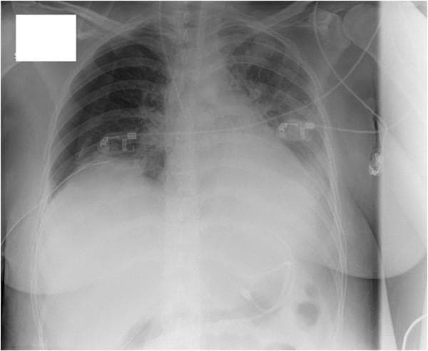 Anteroposterior (AP) chest X-ray demonstrating several critical acute findings. The right hemithorax shows a 'mantle' pneumothorax, evidenced by a thin, peripheral lucency along the apical and lateral lung margins where pulmonary markings are absent, indicating a partial lung collapse. The left lung field displays diffuse, hazy interstitial infiltrates, particularly prominent in the mid-to-lower zones, suggesting interstitial lung disease or inflammatory processes like acute eosinophilic pneumonia. Additionally, there is a left-sided pleural effusion, characterized by the blunting of the left costophrenic angle and an increased basilar density. Monitoring and support equipment are visible, including ECG electrodes and cabling superimposed on the thorax. The radiograph is essential for identifying secondary pulmonary complications, such as spontaneous pneumothorax, in critically ill patients. No obvious cysts, bullae, or cavitary lesions are identified in this view.