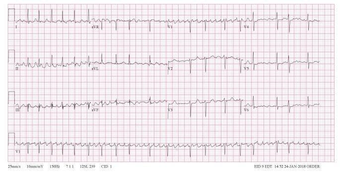 This diagnostic image is a standard 12-lead electrocardiogram (ECG) demonstrating coarse atrial fibrillation. The tracing displays a classic 'irregularly irregular' rhythm with no discernible pattern to the R-R intervals. Key features include the absence of distinct, organized P waves, which are replaced by rapid, continuous, and chaotic fibrillatory (f) waves. These waves are particularly prominent in lead V1 (bottom-most strip), showing significant variation in amplitude, morphology, and rate. This 'coarse' appearance can mimic the saw-tooth pattern of atrial flutter; however, the lack of a constant baseline and the presence of subtle variations in the atrial waveforms support the diagnosis of atrial fibrillation. The QRS complexes are narrow, indicating normal ventricular conduction. This visual is an essential educational tool for cardiology, teaching the distinction between different supraventricular tachyarrhythmias based on atrial activity characteristics and rhythm regularity.