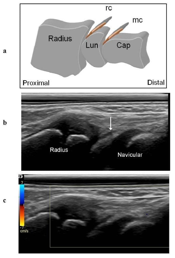 This composite educational graphic illustrates the normal ultrasonographic appearance of the dorsal wrist recesses. (a) An anatomical diagram in the sagittal plane shows the proximal-to-distal orientation of the radius, lunate (Lun), and capitate (Cap) bones, highlighting the dorsal synovial recesses of the radio-carpal (rc) and midcarpal (mc) joints. (b) A corresponding dorsal sagittal grey-scale ultrasound (US) scan demonstrates the thin, hypoechoic radio-carpal recess (indicated by a white arrow) situated between the distal radius and the navicular (scaphoid) bone. The bone surfaces appear as hyperechoic lines with posterior acoustic shadowing. (c) A color Doppler ultrasound image of the same region shows an absence of signal within the synovial recesses, indicating a lack of hyperemia, which is characteristic of a normal, non-inflamed joint state. These images serve as a clinical reference for distinguishing normal musculoskeletal anatomy from synovial hypertrophy or active synovitis in pediatric or adult patients.