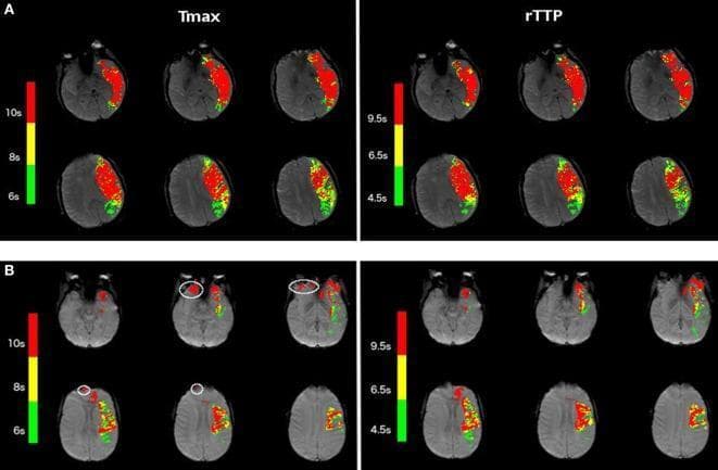 This diagnostic image displays a comparison of Tmax (Time to Maximum) and relative Time to Peak (rTTP) perfusion maps in two acute stroke patients. The image is divided into two sections, A and B, each showing six axial brain slices with color-coded perfusion deficits. In patient example A, there is a clear spatial correspondence between Tmax and rTTP maps, demonstrating high correlation in lesion volume and shape within the left hemisphere. The color scale uses red (severe delay, >10s for Tmax; >9.5s for rTTP), yellow (moderate delay), and green (mild delay, >6s for Tmax; >4.5s for rTTP) to represent hypoperfusion intensity. Example B highlights the susceptibility of different modalities to artifacts; white contours on the Tmax map identify small, localized artifacts that are absent or less prominent on the corresponding rTTP map. These maps are critical in neuroradiology for assessing tissue at risk (penumbra) during acute ischemic stroke and evaluating the technical accuracy of perfusion-weighted imaging parameters.