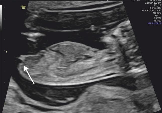 This diagnostic ultrasound image shows a midline sagittal view of a human fetus at 13 weeks of gestation during the first trimester. The fetus is oriented horizontally with its caudal end positioned toward the left of the frame. The primary educational focus is fetal sex determination through the assessment of the genital tubercle. A white arrow points to the genital tubercle located at the caudal extremity of the fetal torso. The tubercle is oriented parallel (at an angle of less than 30 degrees) to the horizontal axis of the fetus, which is a sonographic marker indicative of female gender development. The image clearly demonstrates the relationship between the genital tubercle and the lumbosacral spine/rump contour. This technique is clinically significant in prenatal screening for early gender identification and the evaluation of normal external genitalia development.