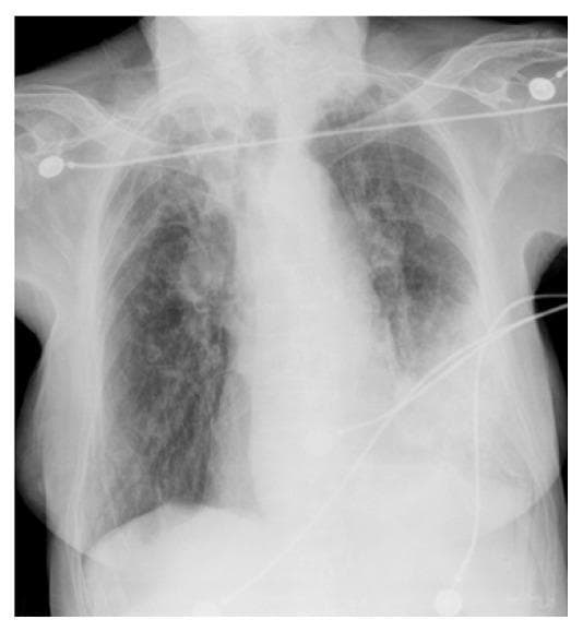 This diagnostic image is an anteroposterior (AP) chest X-ray. The primary clinical finding is a dense, focal opacification in the left lower lobe, consistent with an alveolar infiltrate or consolidation. The left costophrenic angle is partially obscured by the increased density, which borders the cardiac silhouette. In contrast, the right lung field appears relatively clear of acute consolidation, though some mild interstitial markings are visible. Multiple radiopaque medical artifacts are present, including electrocardiogram (ECG) leads and wires superimposed over the thoracic cavity, indicating acute care monitoring. The mediastinal contour appears stable, and the trachea is midline. This imaging is characteristic of community-acquired pneumonia, specifically localized to the left basal region, often associated with pathogens like Moraxella catarrhalis in appropriate clinical contexts.