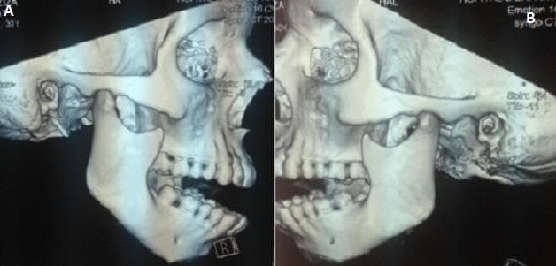 This diagnostic image displays a three-dimensional (3D) CT reconstruction of the human skull in two lateral views, labeled A (right) and B (left). The images illustrate a bilateral temporomandibular joint (TMJ) dislocation. Anatomical landmarks include the mandible, maxilla, zygomatic arch, and temporal bone. In both reconstructions, the mandibular condyle is visibly displaced anterior and superior to the articular eminence of the temporal bone, residing outside the glenoid fossa. This positioning results in a significant misalignment of the mandible relative to the skull base, consistent with an acute bilateral anterior TMJ luxation. The dental arches are visible, showing an inability to achieve normal occlusion due to the condylar displacement. Other maxillofacial structures, including the orbit and zygoma, appear intact without evidence of fracture. This visual serves as an educational tool for identifying the radiographic presentation of jaw dislocation in maxillofacial surgery and emergency medicine.