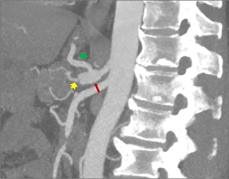 This diagnostic image is a sagittal Maximum Intensity Projection (MIP) from a CT Angiography (CTA) of the upper abdomen, demonstrating the vascular anatomy of the celiac axis. The image shows the abdominal aorta running anterior to the lumbar vertebral bodies. A red arrow highlights a focal dilatation of the celiac trunk at its origin. Branching from this trunk, a green arrowhead identifies a patent and prominent left gastric artery, while a yellow arrowhead indicates the splenic artery, which appears patent but exhibits a thick-walled morphology. The superior mesenteric artery is also visible inferior to the celiac trunk. This clinical imaging is essential for evaluating vascular pathologies such as aneurysmal dilatation, stenosis, or occlusion in patients presenting with acute abdominal symptoms. The anatomical relationship between the major visceral arteries and the spine is clearly depicted, serving as an educational tool for radiology and vascular surgery specialties.