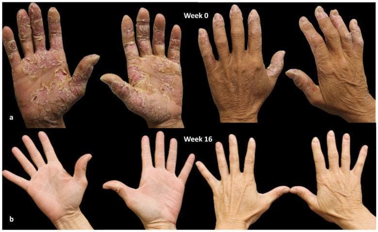 Clinical photograph comparison of chronic hand eczema (CHE) at baseline (Week 0) and 16 weeks post-treatment with dupilumab. Row A (Week 0) displays severe dermatological manifestations with a Hand Eczema Severity Index (HECSI) of 270. Key features include diffuse erythema, thick hyperkeratotic plaques, extensive scaling, and painful fissuring. The palmar surfaces are most affected, showing yellowish, cracked lesions and desquamation, particularly on the thumbs and central palms. The dorsal surfaces exhibit milder scaling and lichenification. Row B (Week 16) demonstrates a dramatic clinical response with a HECSI score of 0. There is a complete resolution of active lesions, erythema, and scaling. The skin texture has returned to a normal, supple appearance with uniform pigmentation and restored epidermal integrity across both palmar and dorsal aspects. This comparison illustrates the efficacy of biologic therapy in managing severe, refractory chronic hand eczema by targeting underlying inflammatory pathways.