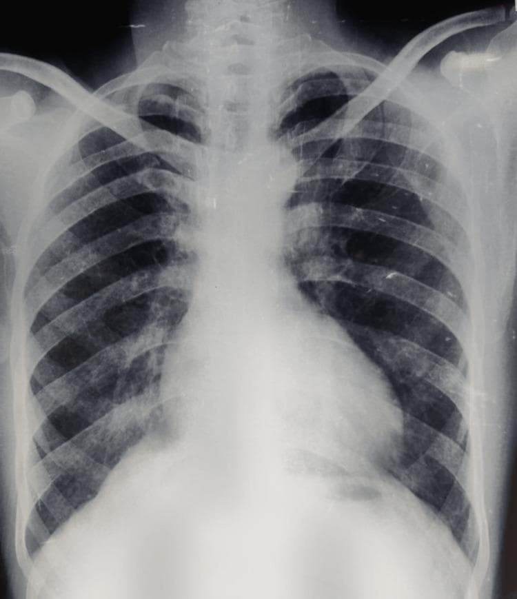 A posteroanterior (PA) chest X-ray of an adult male demonstrating classic radiological features associated with Tetralogy of Fallot (TOF). The cardiac silhouette exhibits mild cardiomegaly and a characteristic 'boot-shaped' heart (coeur en sabot). This morphology is defined by an upturned, rounded cardiac apex, indicating right ventricular hypertrophy, and a concave pulmonary artery segment (pulmonary conus). The lung fields appear relatively oligemic, reflecting decreased pulmonary blood flow typical of right-to-left shunting or pulmonary stenosis. No acute pulmonary infiltrates or pleural effusions are visible. The costophrenic angles are clear. This diagnostic image is intended for medical students and clinicians to identify visual markers of cyanotic congenital heart disease and right ventricular pressure overload in an adult clinical presentation.