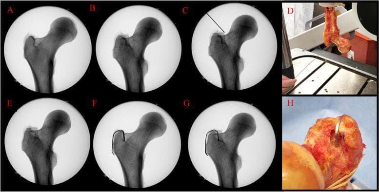 This composite figure consists of radiographic and clinical photographs investigating the anatomical origin of the radiographic lines on the proximal femur, specifically the medial greater trochanter. Images A and B are fluoroscopic views showing how femoral rotation (0° vs 30°) affects the alignment of the anterior and posterior trochanteric lines; at 0°, the lines are superimposed, while at 30°, they separate. Images C and D demonstrate a Kirschner wire (K-wire) placed in line with the posterior line, illustrating its physical anatomical landmark. Image E shows the disappearance of the anterior line following focal cortical bone removal at 30° rotation. Images F and G illustrate the reappearance of these lines when a radiopaque lead strip is placed in the surgical void at 0° and 30°, respectively. Clinical photographs D and H show the experimental setup of the cadaveric femur and the lead strip placement in the trochanteric fossa. This study is clinically relevant for orthopedic templating in total hip arthroplasty (THA), where precise femoral rotation is critical for accurate femoral offset measurement.