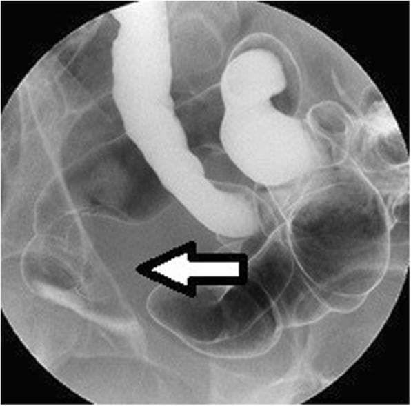 This diagnostic image is a barium enema (single-contrast radiography) of the pelvic region focusing on the distal large intestine. The radiograph displays the rectum and sigmoid colon filled with radiopaque barium contrast. A prominent finding is a 40-mm extramural mass located in the rectum, indicated by a white arrow. This mass manifests as a smooth, rounded indentation and outward distortion of the rectal wall contour, suggesting an external compressive force rather than an intraluminal mucosal lesion. The surrounding anatomical structures are visible through faint gas and contrast shadows. Such findings are clinically significant in the diagnostic workup of extrinsic pelvic masses, including intestinal endometriosis or gastrointestinal stromal tumors (GIST), particularly when mucosal findings on colonoscopy are absent. This material is suitable for intermediate to advanced medical learners studying gastrointestinal radiology and surgical pathology.