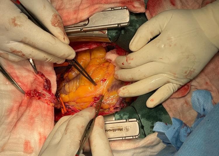 A close-up clinical photograph of an intraoperative field during a coronary artery bypass graft (CABG) surgery. The image shows a median sternotomy with the heart exposed and stabilized by a sternal retractor. The epicardial surface of the heart is visible, notably characterized by significant yellowish epicardial adipose tissue. Surgeons in sterile gloves use fine surgical forceps to isolate and stabilize the left anterior descending (LAD) artery for anastomosis. A harvested conduit, identified as the right internal mammary artery (RIMA), is being positioned toward the patient's head to facilitate the distal anastomosis. Surrounding the cardiac structures are blood-stained surgical drapes, gauze sponges, and specialized cardiothoracic retractors (Medtronic). The image illustrates the complex surgical positioning required for revascularization in a patient with dextrocardia and situs inversus, emphasizing the technical precision needed for arterial tunneling and suturing in a reversed anatomical orientation.