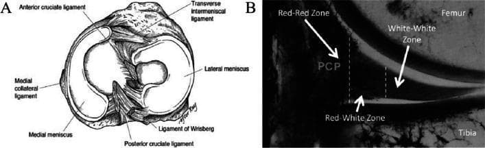 This dual-panel educational figure illustrates the gross and microvascular anatomy of the human knee meniscus. Panel A is a superior-view anatomical diagram of the tibial plateau, highlighting the C-shaped medial meniscus and circular lateral meniscus. Key supporting structures are labeled, including the anterior and posterior cruciate ligaments, the transverse intermeniscal ligament, the medial collateral ligament, and the ligament of Wrisberg. Panel B is a frontal-section diagnostic image of the knee's medial compartment following India ink perfusion to demonstrate vascularity zones. It identifies three distinct regions critical for surgical repair assessment: the peripheral 'Red-Red Zone' (highly vascularized, appearing dark from ink perfusion), the central 'White-White Zone' (avascular, appearing bright), and the transitional 'Red-White Zone' located between them. The image serves to educate on the spatial relationship between meniscal fibrocartilage, ligamentous attachments, and the graded blood supply that dictates the intrinsic healing potential of meniscal tears.