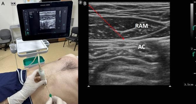 This dual-panel image demonstrates the clinical and sonographic components of a rectus sheath block (RSB), a regional anesthesia technique targeting T7-T12 spinal nerve endings. Panel A is a clinical photograph showing a patient in the supine position for a mid-abdominal intervention. A clinician, wearing sterile gloves, is performing the procedure using a high-frequency linear ultrasound probe placed in a transverse orientation over the rectus abdominis muscle. A block needle is visible being inserted in-plane toward the target site. An ultrasound monitor in the background displays the real-time procedural imaging. Panel B is a corresponding musculoskeletal ultrasound image (sonogram) labeling the relevant anatomy. The rectus abdominis muscle (RAM) is identified as a hypoechoic, spindle-shaped structure with internal fibrillar striations. Deep to the RAM is the abdominal cavity (AC), appearing heterogeneous and hyperechoic due to bowel interfaces. A red dashed arrow indicates the needle's trajectory, targeting the potential space between the posterior aspect of the rectus muscle and the posterior rectus sheath to deliver local anesthetic.