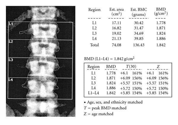 This diagnostic image and data summary illustrate a Dual-energy X-ray Absorptiometry (DEXA) scan of the lumbar spine (L1-L4) used for bone mineral density (BMD) assessment. The visual component features a posterior-anterior (PA) view of the lumbar vertebrae, where each vertebral body (L1, L2, L3, L4) is segmented and delineated by rectangular regions of interest (ROI). Accompanying tables provide quantitative data including estimated area (cm²), Bone Mineral Content (BMC in grams), and BMD (g/cm²). The total BMD for L1-L4 is reported as 1.842 g/cm², with significantly elevated T-scores and Z-scores reaching +5.85. This clinical finding indicates abnormally high bone density, which is essential for diagnosing conditions like osteopetrosis or sclerosing bone dysplasias in endocrinology and orthopedics. The educational focus is on the interpretation of DEXA scan outputs and the recognition of supra-normal bone density values.
